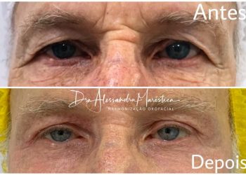 Blefaroplastia não-cirúrgica