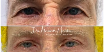 Blefaroplastia não-cirúrgica