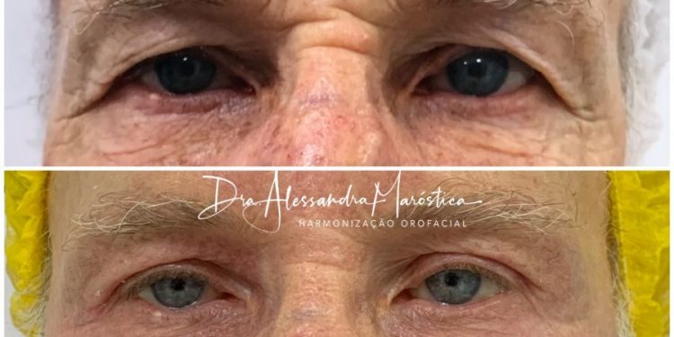 Blefaroplastia não-cirúrgica