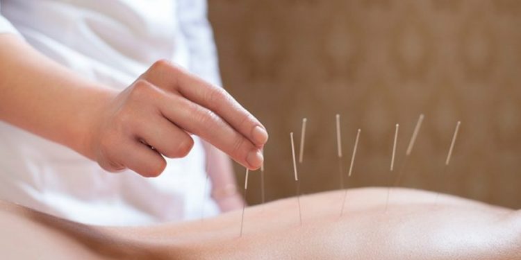 Tratamento com acupuntura para dores disponível em UBSs da Zona Leste