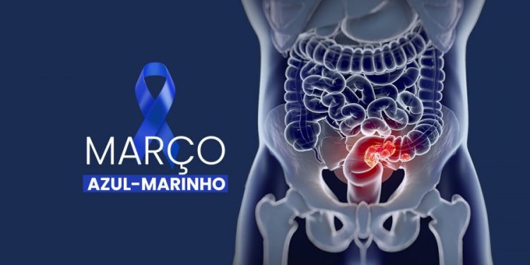 Diagnóstico precoce é essencial para a prevenção do câncer colorretal