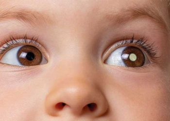 Alerta sobre a importância do diagnóstico precoce da retinoblastoma