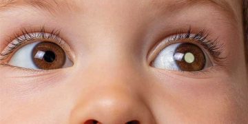 Alerta sobre a importância do diagnóstico precoce da retinoblastoma